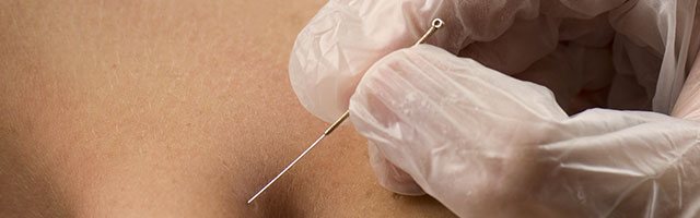 dry needling